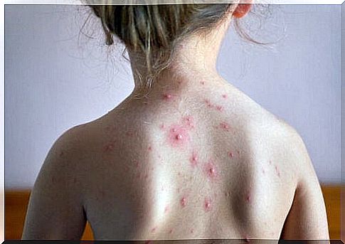 Are chickenpox more common in the spring?