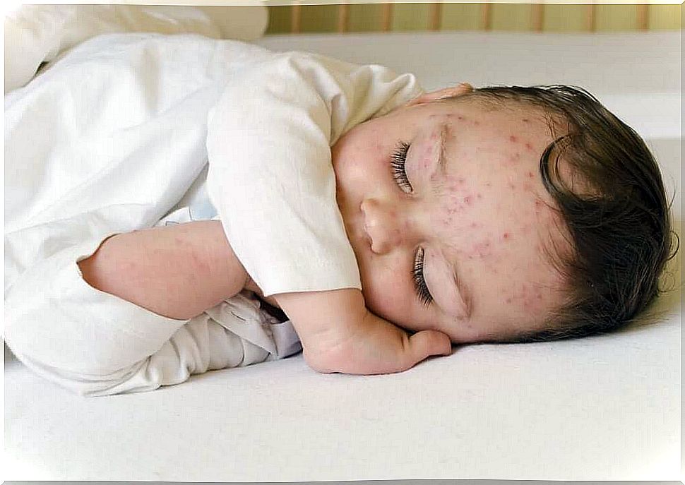 A baby with chickenpox