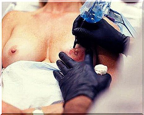 Woman getting new nipple tattooed - femininity after breast cancer