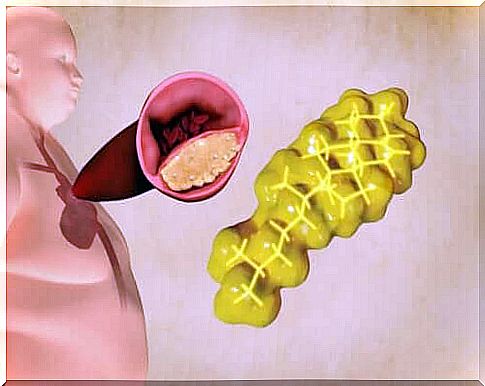 Accumulation of fat around the heart