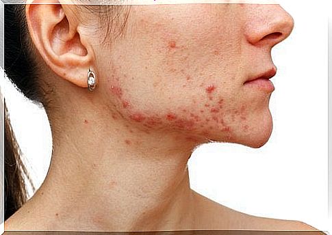 Woman with acne on face