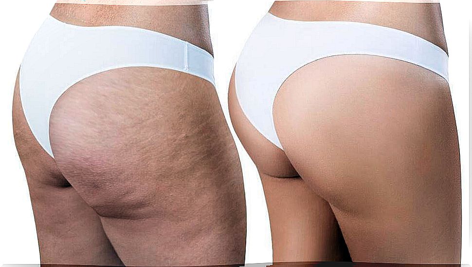 Get rid of cellulite with these easy remedies