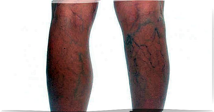 varicose veins on the legs