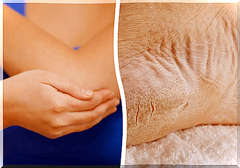 Get rid of dry elbows and feet in 1 week