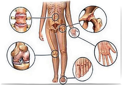 Joint pain: Five natural anti-inflammatory drugs