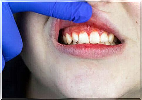 Origin, symptoms and treatment of trench mouth