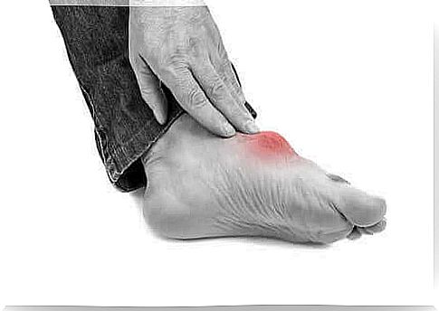 Foot with arthritis caused by purine