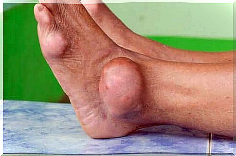 Foot with severe arthritis