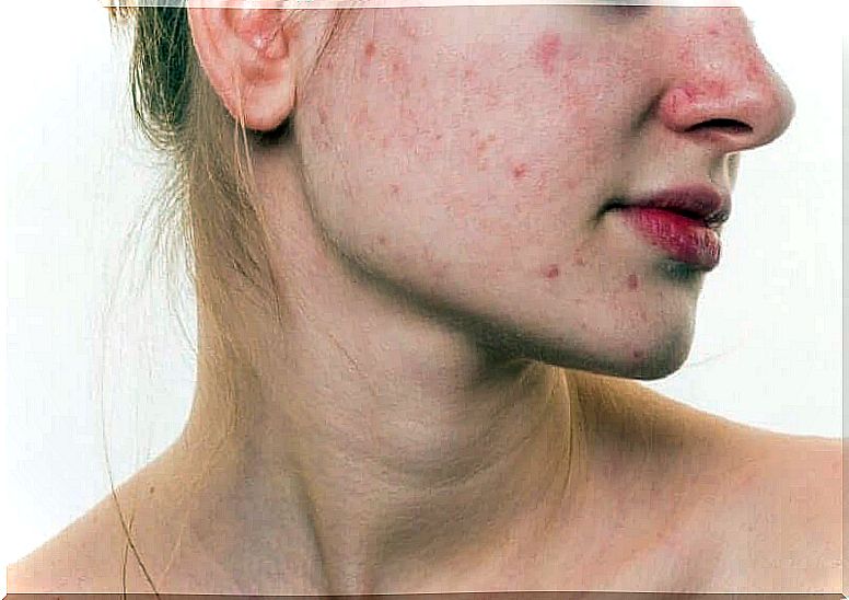 A woman with acne