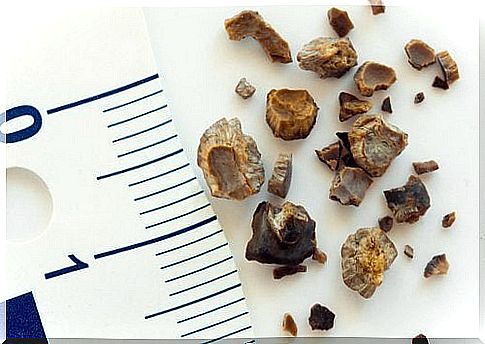 Kidney stone