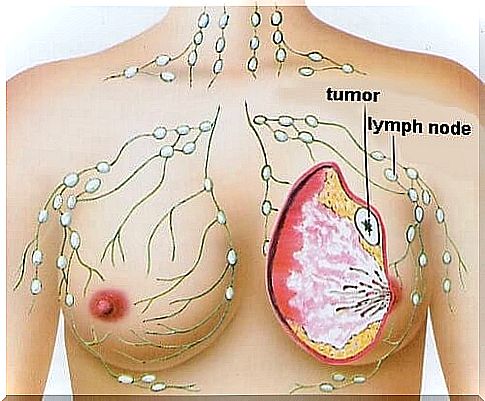 The 5 most common types of cancer in women