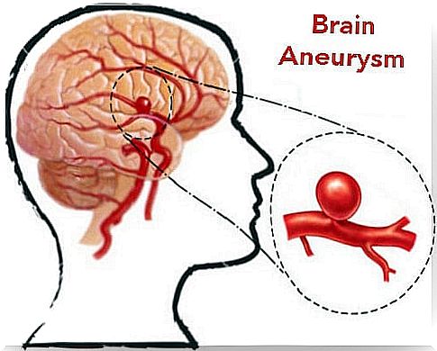 What you should know: Detect and prevent aneurysms