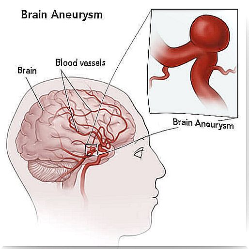 Prevent-Aneurysms-2