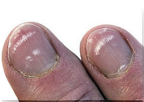 Why do you get white spots on your nails?